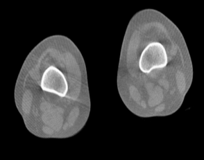 WR-3D axial knee reconstruction for weight-bearing knee joint assessment