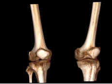 WR-3D 3D knee reconstruction for orthopedic joint assessment
